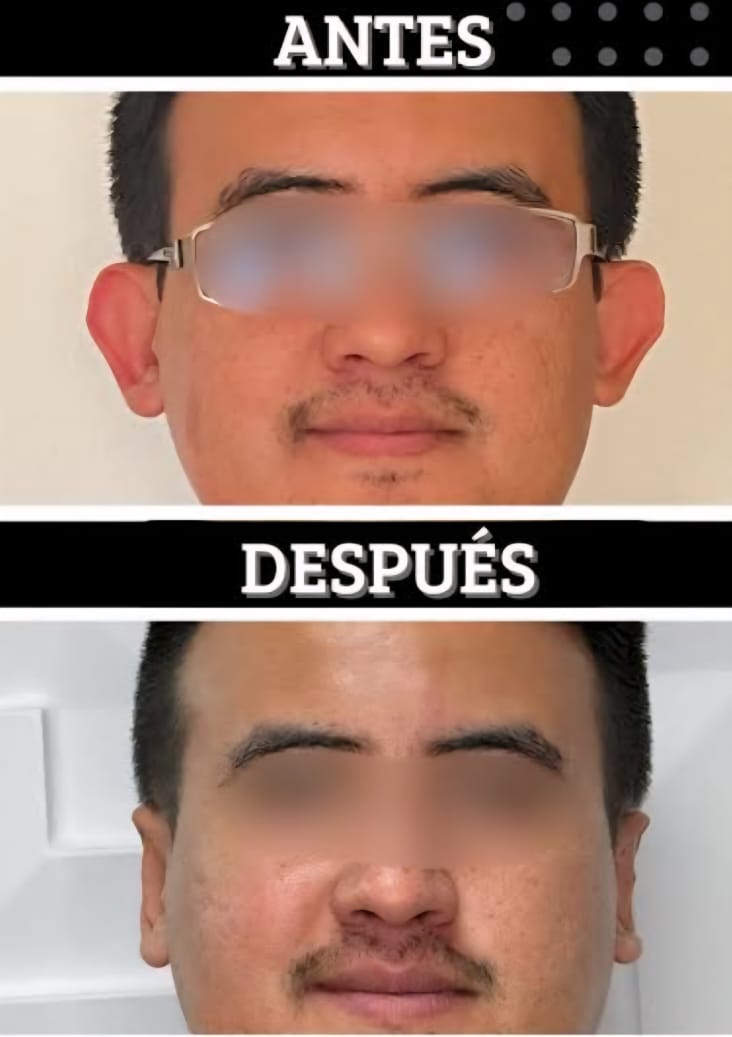 Resultado Otoplastia 7